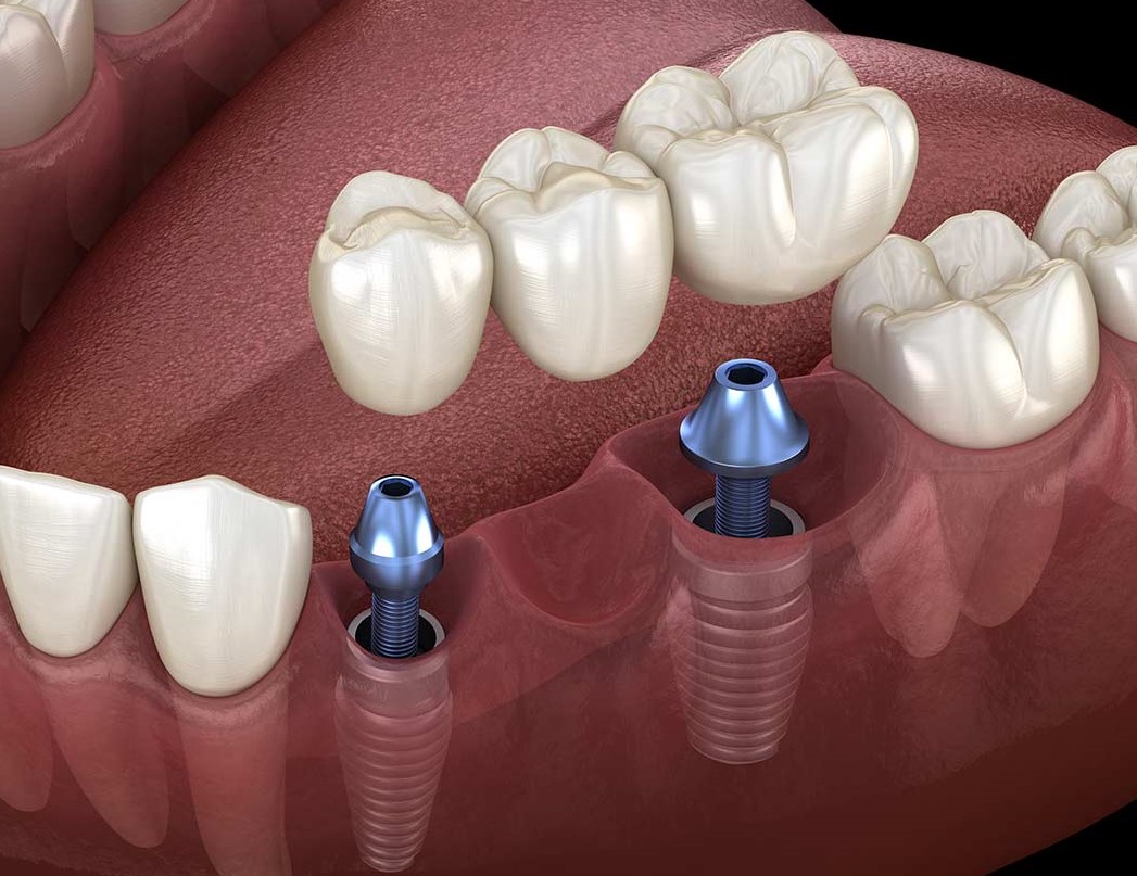 dental implants care