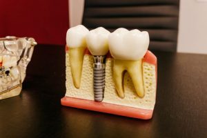 benefits of dental implantation