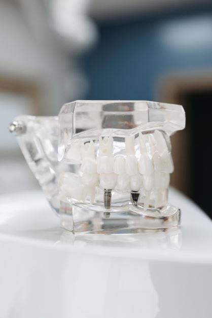 dental implant or bridge