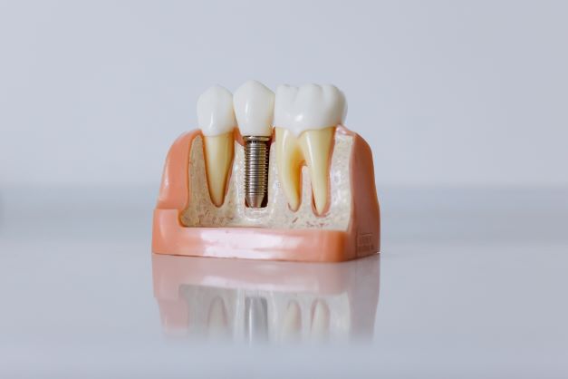 connected dental implant teeth or not? 