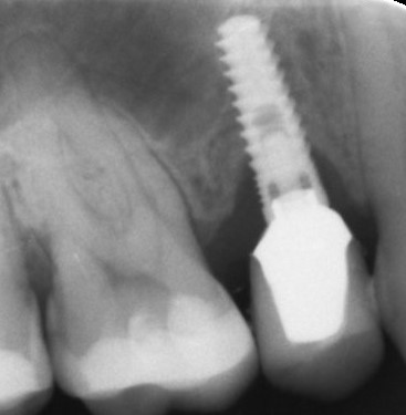 bone loss around dental implants