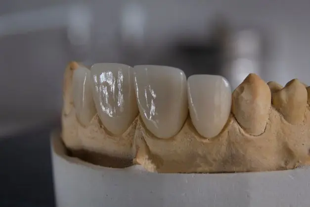 porcelain crowns for gaps