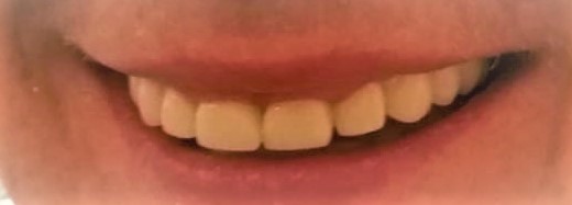  without gaps between teeth