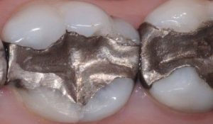 before replace amalgam fillings