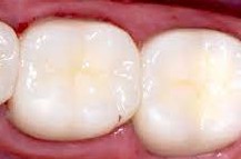 after replace amalgam fillings with composite ones