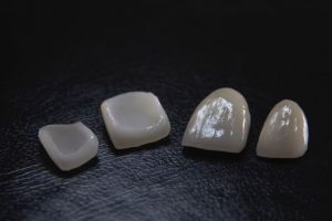 cavities behind veneers 