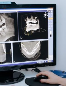 infection under veneer